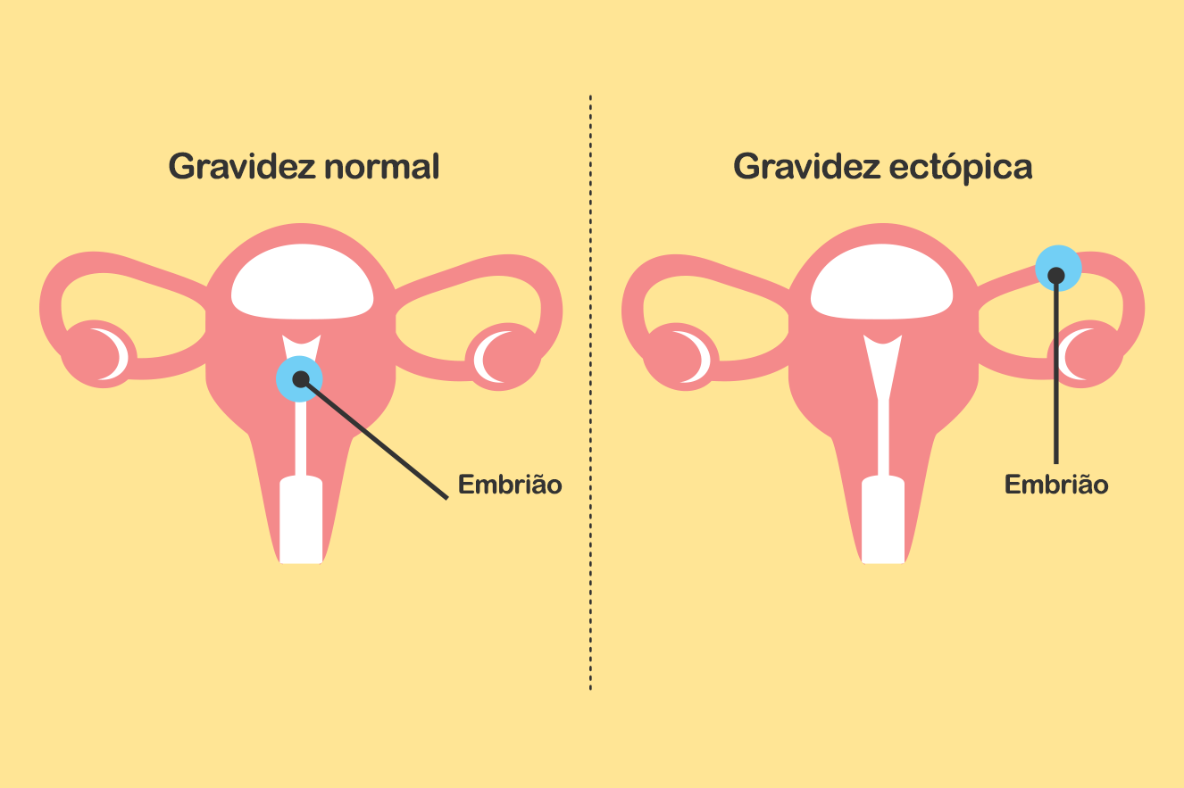 Gravidez normal x gravidez ectópica