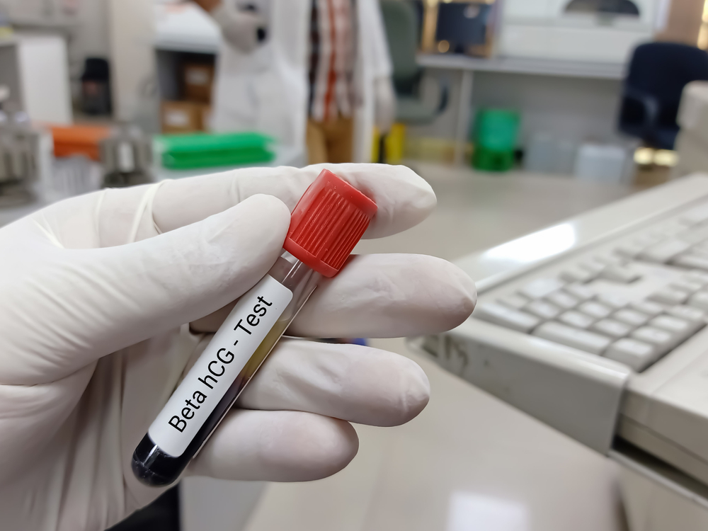 Beta HCG: Conheça o exame e saiba como entender o resultado