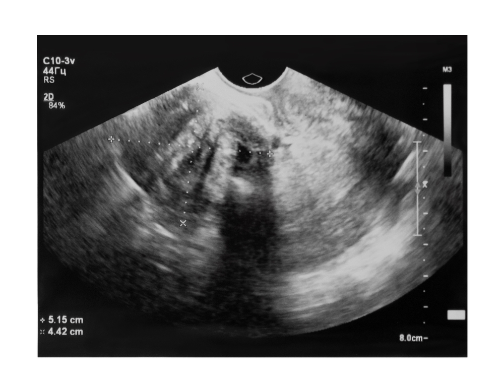Como é feito o diagnóstico de mioma uterino?
