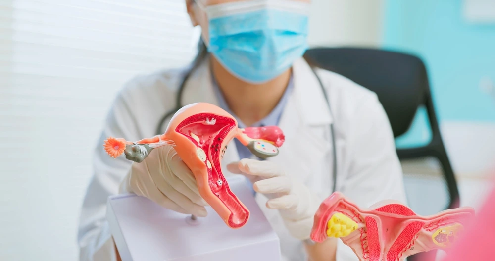 Endometrioma: o que é, sintomas e tratamento