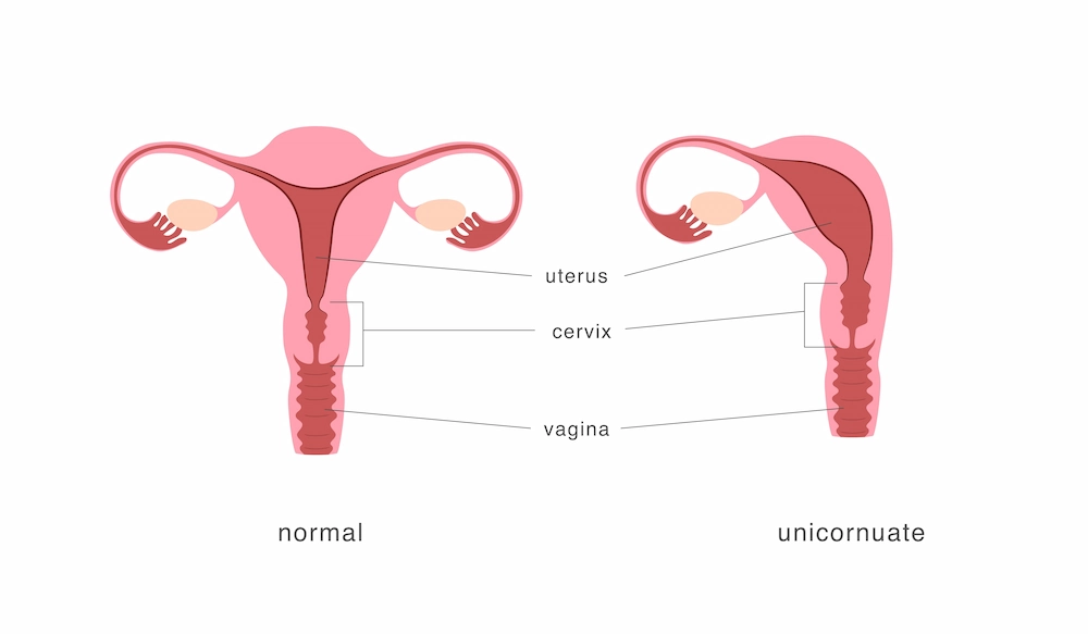 Útero unicorno: o que é e como afeta a fertilidade?